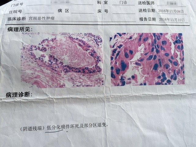 健康 正文  图①2016年11月8日病理切片▲ 图②2016年11月23日送检的