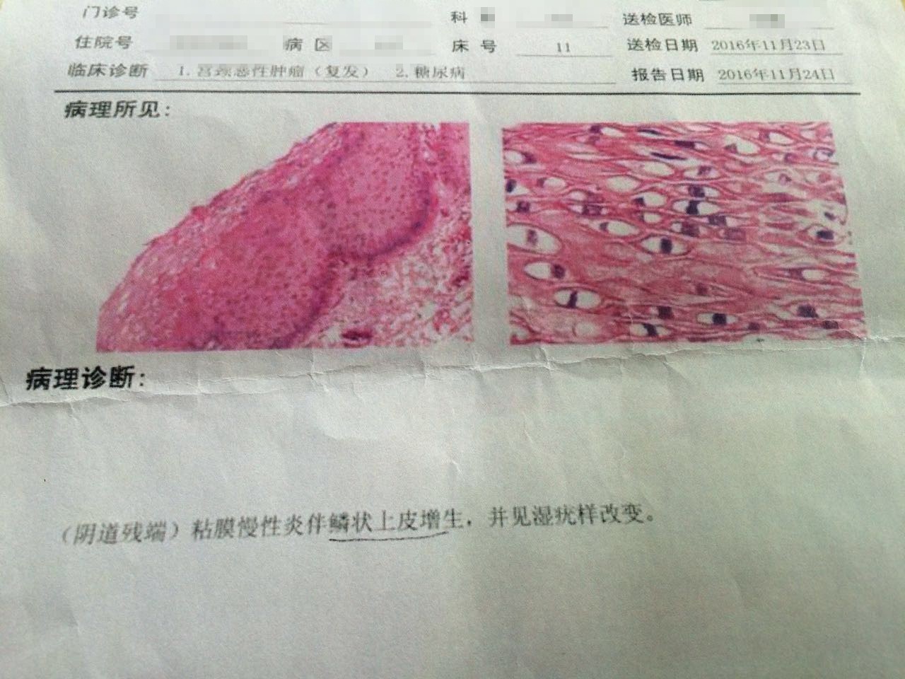 健康 正文  图①2016年11月8日病理切片▲ 图②2016年11月23日送检的