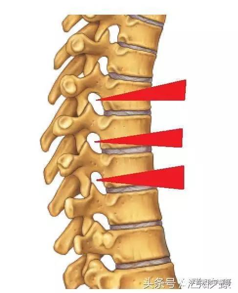 红色箭头所指就是椎间孔