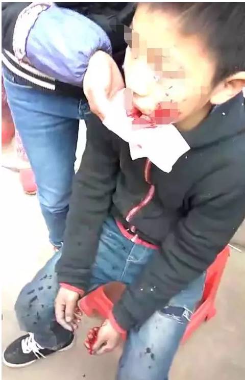 江西赣州一位10岁左右的小男孩 被鞭炮炸伤,嘴唇都炸破了 血流不止