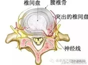 是指突出物向椎间盘的斜后方突出,能够压迫到椎管内的硬膜囊和神经根