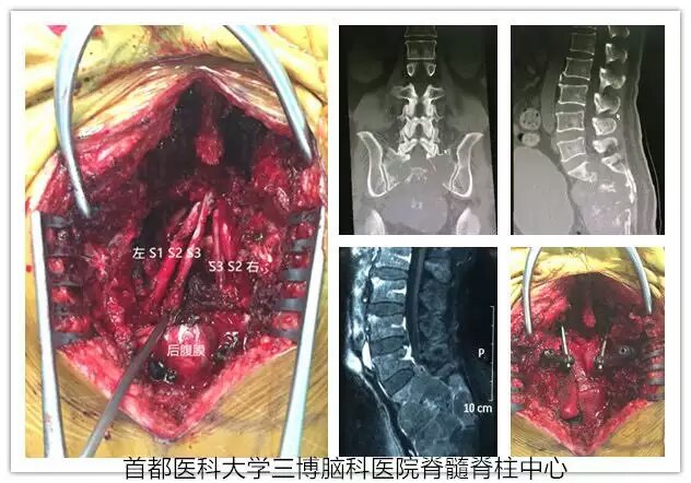 任性的脊柱神经外科手术可从"头"做到"尾"