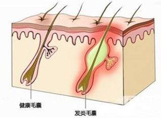 拔完胡子有黑印怎么办