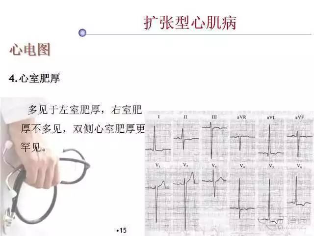 精彩幻灯心肌炎心肌病与心包炎的心电图改变