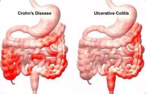 系统异常反应所导致的慢性肠道炎症性疾病,主要包括 克罗恩病(cd)和