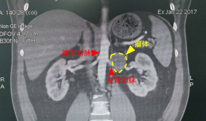 患者ct片冠状面