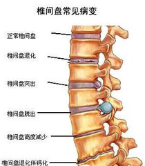 腰突的原理_白领司机腰突真的可以治愈么