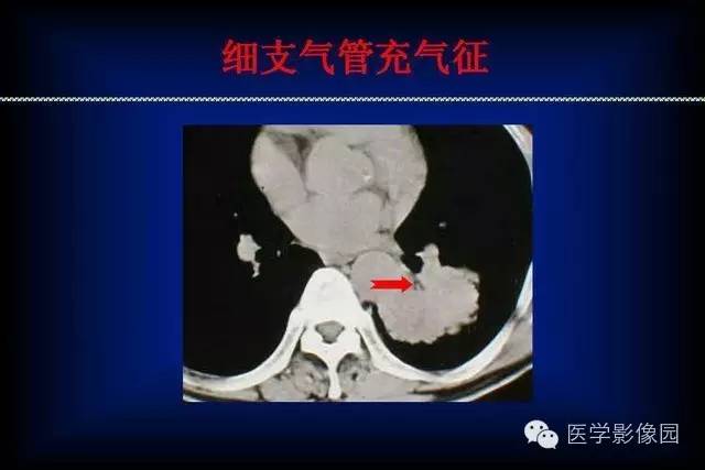 肺癌ct征象及病理基础总结，收藏！ 4170