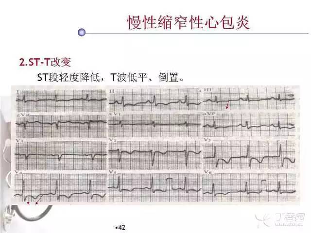 精彩幻灯:心肌炎,心肌病与心包炎的心电图改变