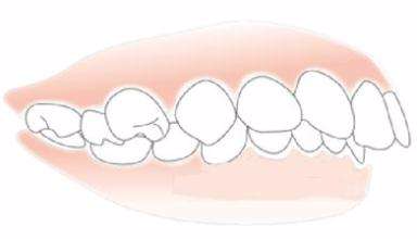 如何诊断牙齿是否深覆合?有哪些有效治疗方法?