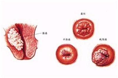 带你深入相识女性癌症第二大杀手 宫颈癌如己新闻