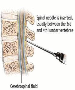 腰椎穿刺术操作流程