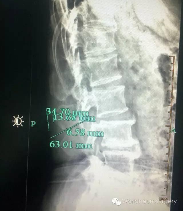 秘诀3---腰椎解剖穿刺点的定位学问很大.