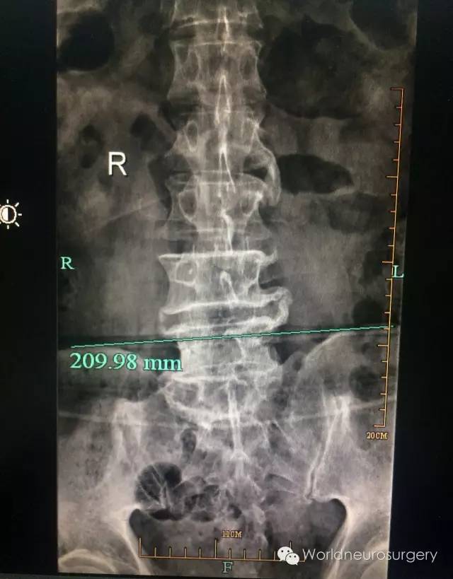 秘诀3---腰椎解剖穿刺点的定位学问很大.