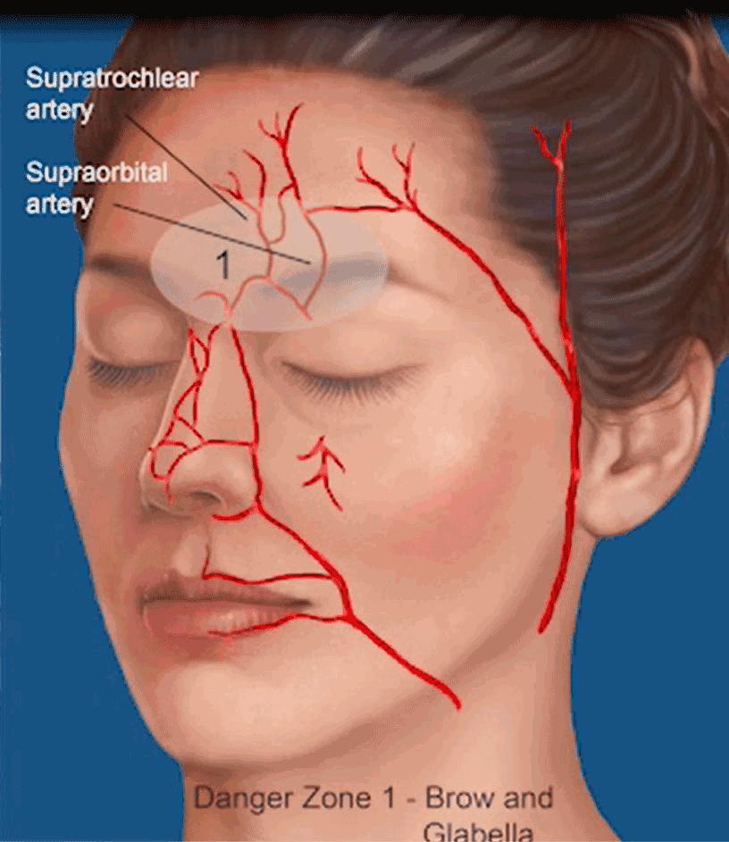 正如许多研究所证实的,面部血管有许多变异,且存在于不同面部位置和
