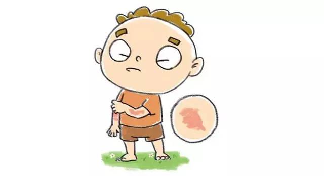 疹子高发期!一分钟分辨水痘、皮炎、荨麻疹和