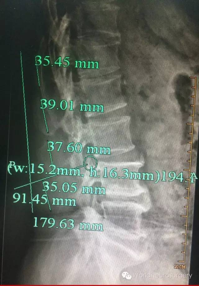 秘诀3---腰椎解剖穿刺点的定位学问很大.