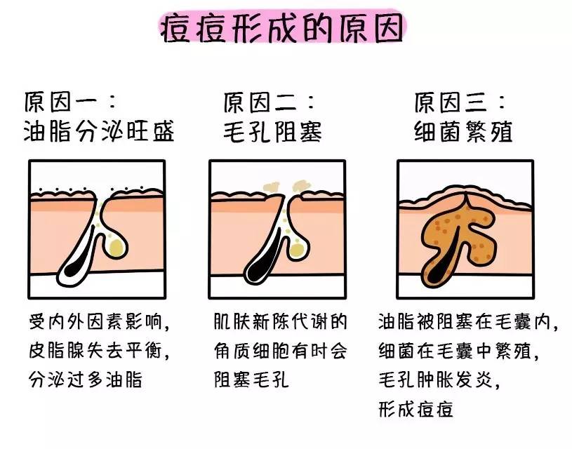 痘痘一旦形成就很让人头疼,但是有些医美项目是专攻祛痘的,有些还能去