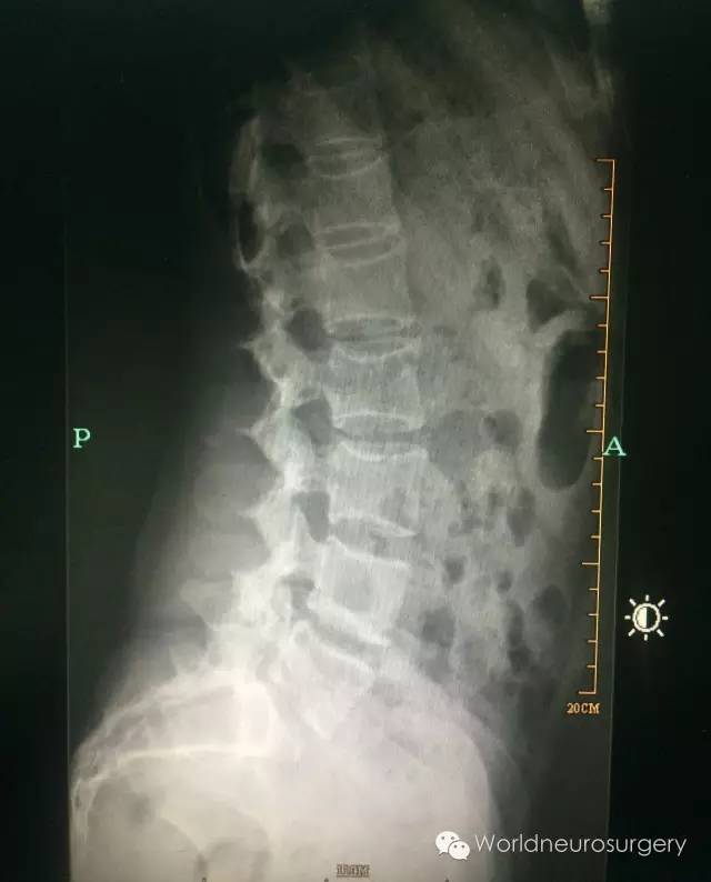 秘诀3---腰椎解剖穿刺点的定位学问很大.