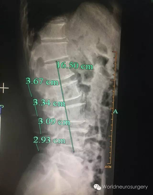 秘诀3---腰椎解剖穿刺点的定位学问很大.