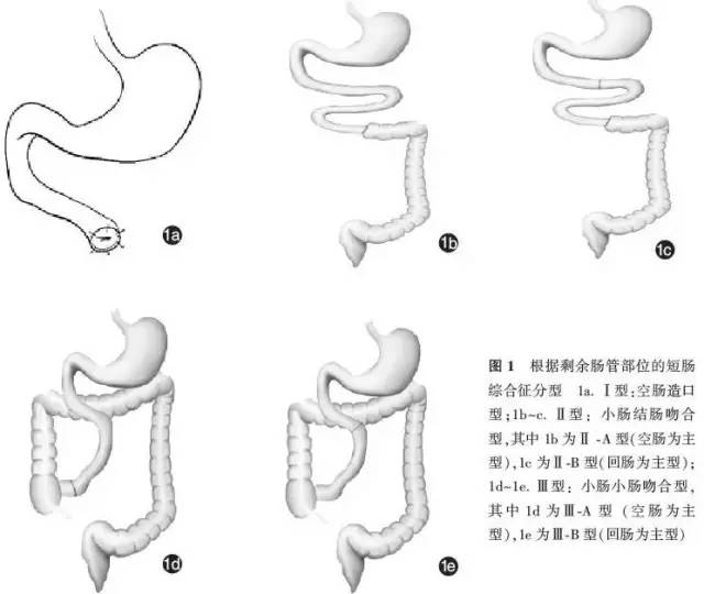 根据剩余肠管长度分型