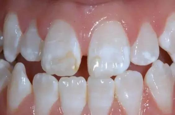 碳水化合物滞留于牙面上所需的时间,牙齿萌出所需的时间,菌斑从形成到