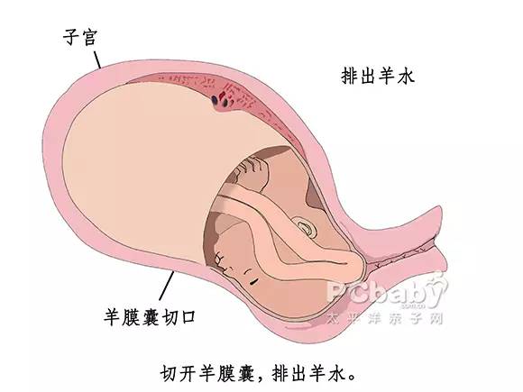 分娩| 剖腹产你要挨几刀?老公们看完请加倍疼她!