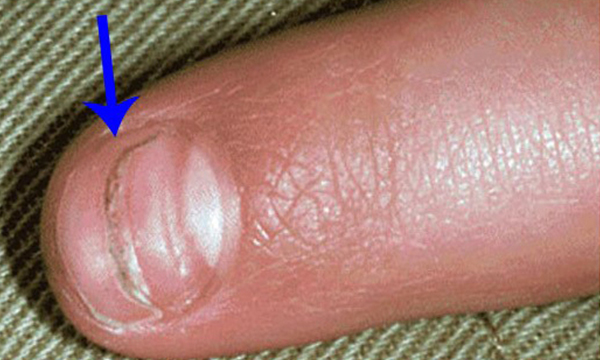 博氏线的出现通常意味着指甲曾经一度停止生长过.