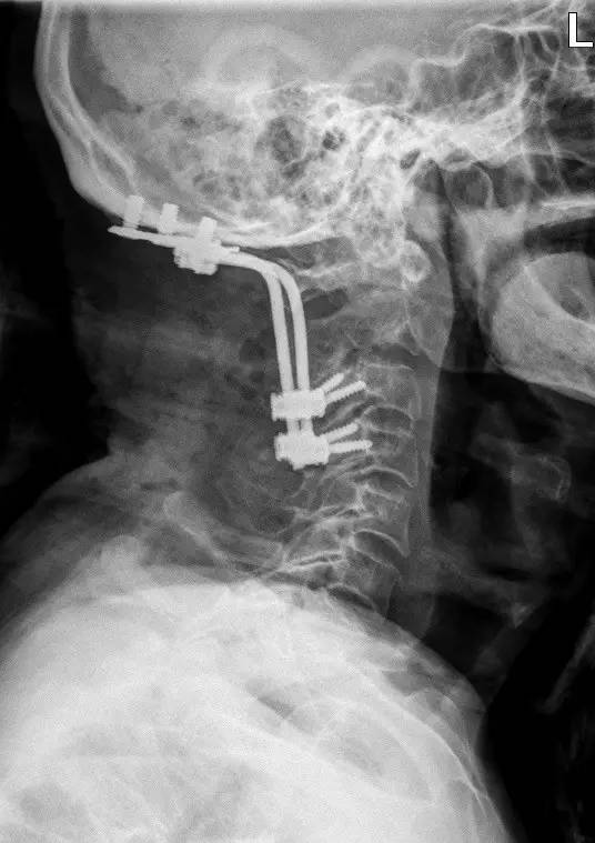 仁济医院脊柱外科成功救治一位93岁高位颈椎