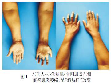 左健康 正文  患者,女性,35岁,农民,以"左手及左前臂肌肉萎缩5年"为