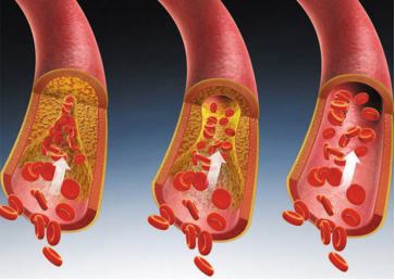 同型半胱氨酸:心脑血管事件的重要指标