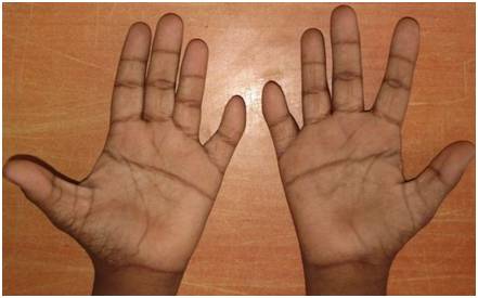 图三:21三体综合征患儿的手掌特征:"断掌"(医学称:通贯掌或猿皱褶)和
