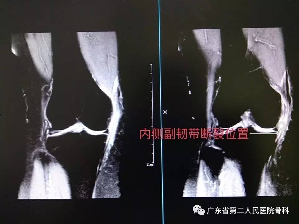 膝关节内侧副韧带损伤与修复案例分享-搜狐