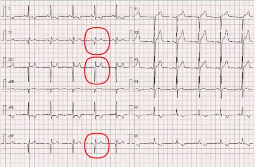 上图,avf导联 均存在q波,avf导联是下壁导联,这是下壁