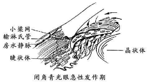 1,这类患者的特征主要是:远视眼,小眼球,短眼轴,窄房角,浅前房,大晶体