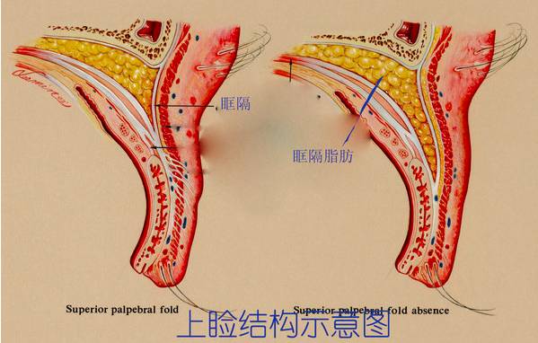 上眼皮凹下去怎么办