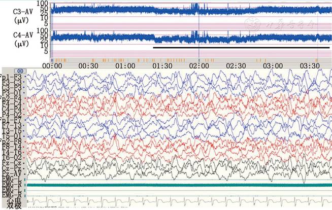 【论著】儿科重症监护病房医护人员应用振幅整合脑电图识别癫痫发作的