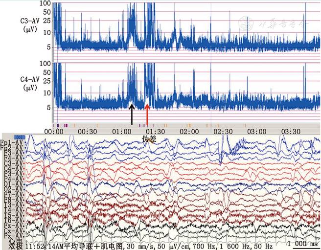 【论著】儿科重症监护病房医护人员应用振幅整合脑电