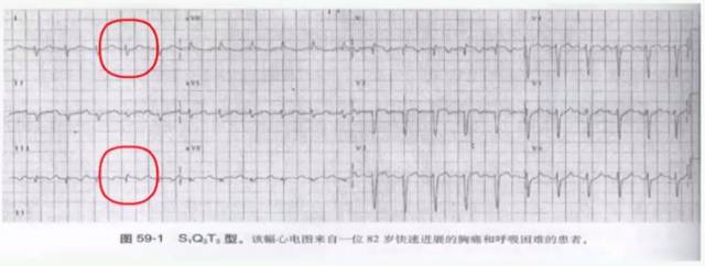 肺栓塞1随后又记录到,虽然心律略慢一点,但是记录到患者胸前导联t波很