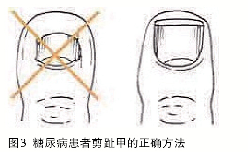 不要到公共浴室修脚;不要自行使用鸡眼膏治疗鸡眼和胼胝(图4);出现