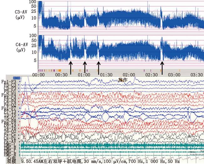 论著儿科重症监护病房医护人员应用振幅整合脑电图识别癫痫发作的可行