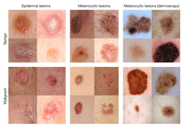 医生们一同区分两种不同的皮肤疾病——角质细胞癌与良性脂溢性角化病