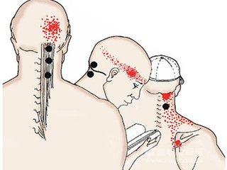 颈源性头痛:一种根源在颈部的头痛