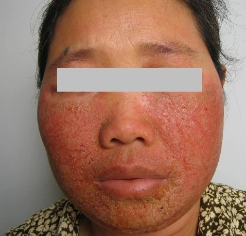 激素脸也就是我们通常所说的激素依赖性皮炎这一皮肤科顽疾,该病是
