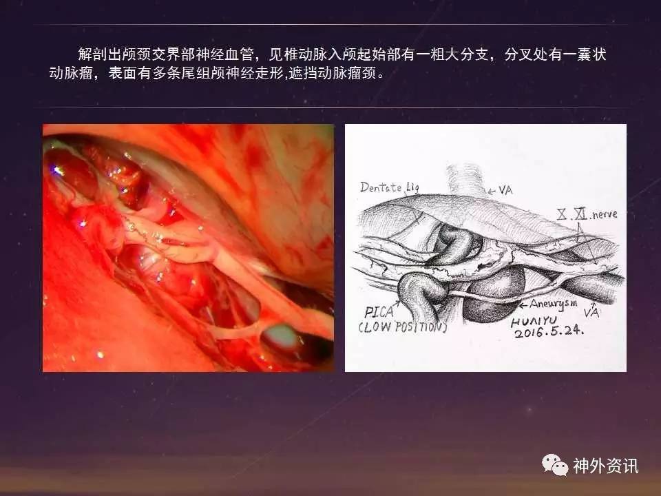 病例分享小脑后下动脉pica动脉瘤显微外科手术2例