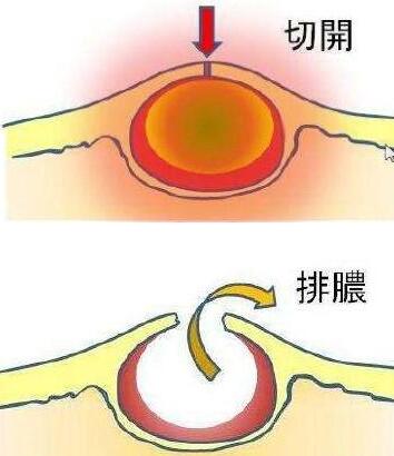 都摸摸耳朵后面长没长硬包专家说要当心