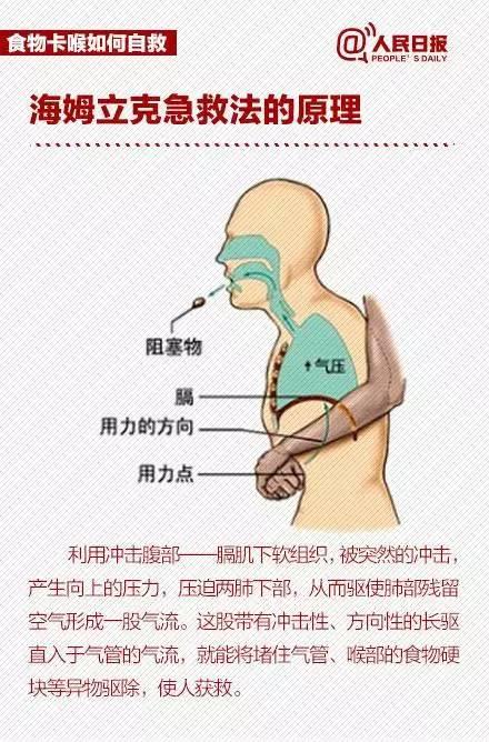 喉咙卡住骨头怎么办