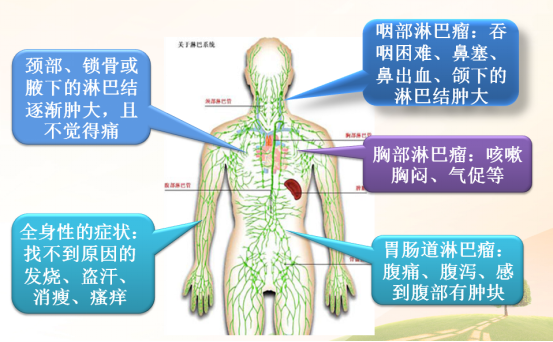 警惕"人体卫士"淋巴细胞"哗变"所致的肿瘤――"淋巴瘤