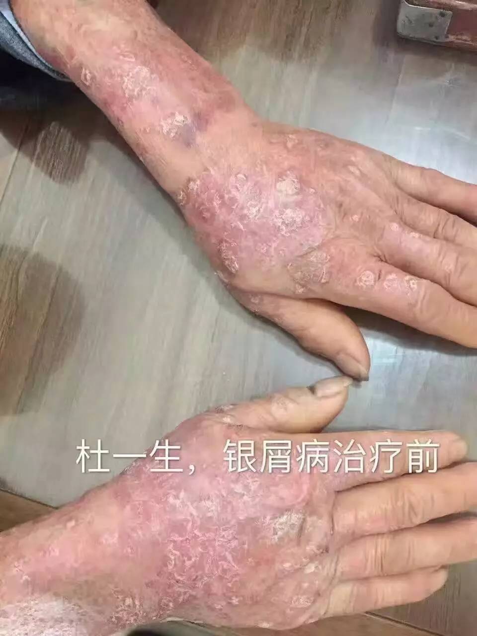 银屑病病因集结,你属于哪一种?