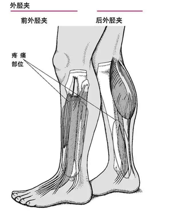 位置为胫骨骨干前方或小腿内侧,病因多种,最常见原因是胫骨周围骨膜
